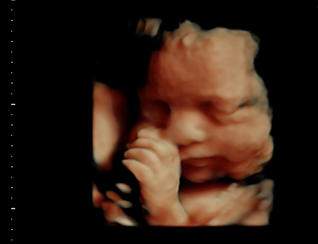 3D ultrasound image at 31 weeks